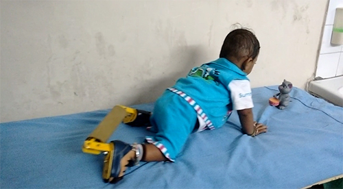 Brace To Assist Children With Clubfoot Promises Freedom From Disability Department Of Science Technology